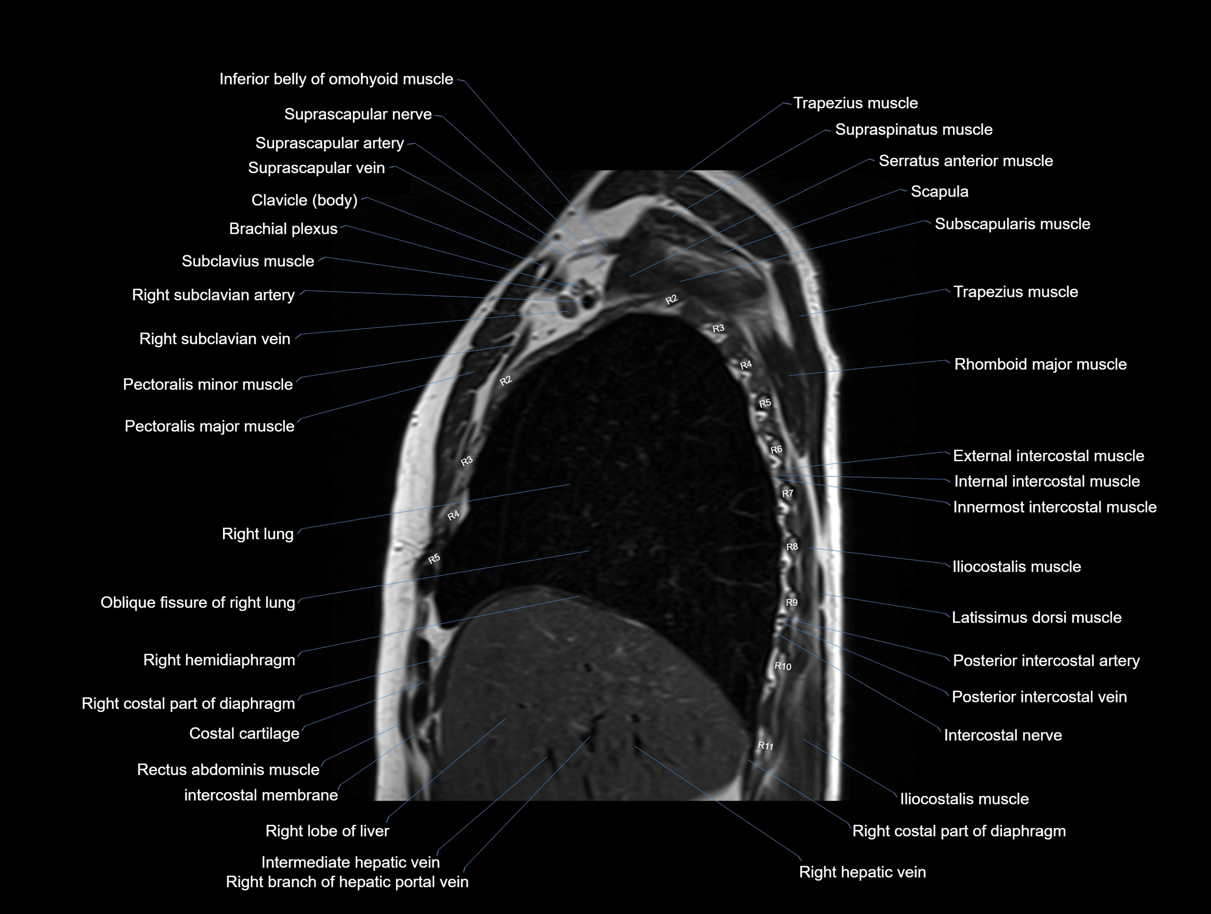 MRI chest (thorax) coronal  cross sectional anatomy 3T radiology  image-img-00001-00011.webp